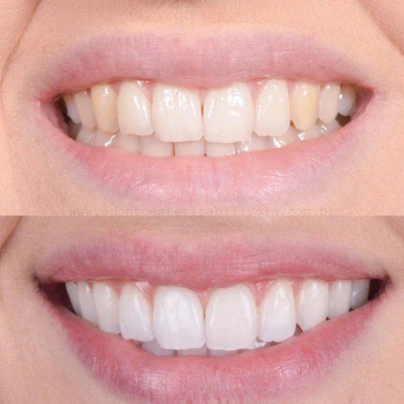 Sbiancamento rapido dei denti per un sorriso splendente