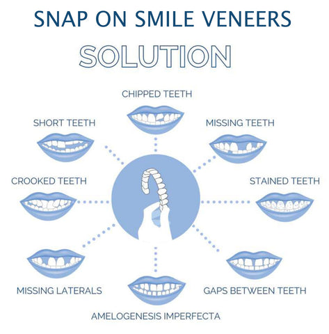 Faccette Dentali (Includono Superiore e Inferiore)